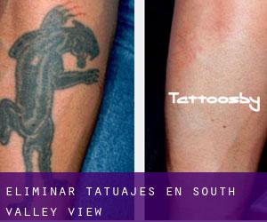 Eliminar tatuajes en South Valley View