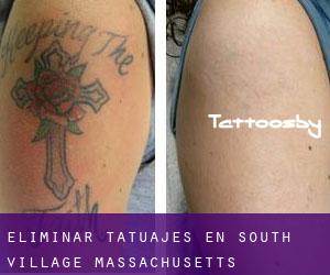 Eliminar tatuajes en South Village (Massachusetts)