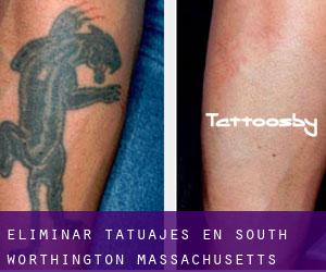 Eliminar tatuajes en South Worthington (Massachusetts)