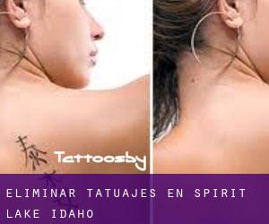 Eliminar tatuajes en Spirit Lake (Idaho)