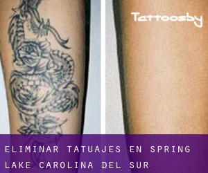 Eliminar tatuajes en Spring Lake (Carolina del Sur)