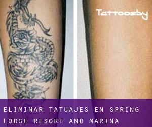 Eliminar tatuajes en Spring Lodge Resort and Marina