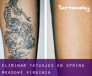 Eliminar tatuajes en Spring Meadows (Virginia)