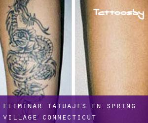 Eliminar tatuajes en Spring Village (Connecticut)