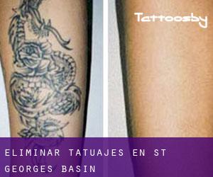 Eliminar tatuajes en St. Georges Basin