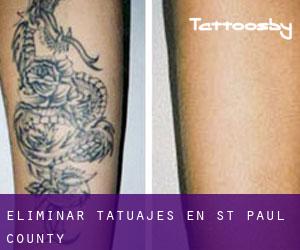 Eliminar tatuajes en St. Paul County
