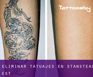 Eliminar tatuajes en Stanstead-Est