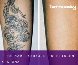Eliminar tatuajes en Stinson (Alabama)