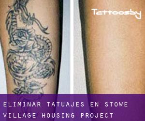 Eliminar tatuajes en Stowe Village Housing Project