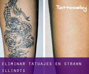 Eliminar tatuajes en Strawn (Illinois)