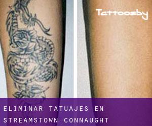 Eliminar tatuajes en Streamstown (Connaught)