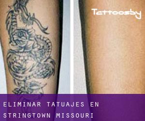 Eliminar tatuajes en Stringtown (Missouri)