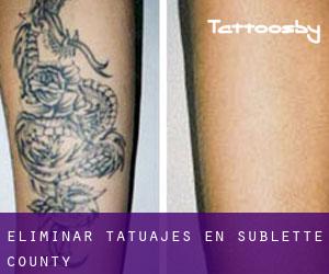 Eliminar tatuajes en Sublette County