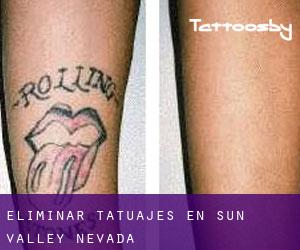 Eliminar tatuajes en Sun Valley (Nevada)
