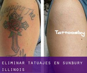 Eliminar tatuajes en Sunbury (Illinois)