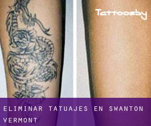 Eliminar tatuajes en Swanton (Vermont)