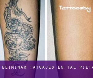 Eliminar tatuajes en Tal-Pietà