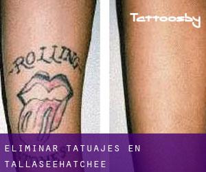 Eliminar tatuajes en Tallaseehatchee