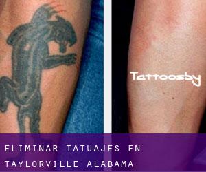 Eliminar tatuajes en Taylorville (Alabama)