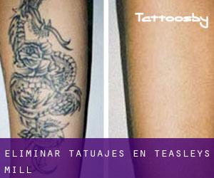 Eliminar tatuajes en Teasleys Mill