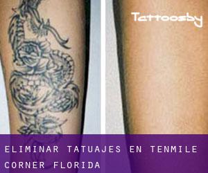 Eliminar tatuajes en Tenmile Corner (Florida)