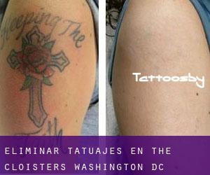 Eliminar tatuajes en The Cloisters (Washington, D.C.)