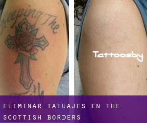 Eliminar tatuajes en The Scottish Borders