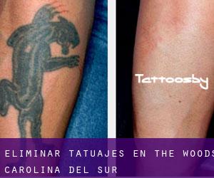 Eliminar tatuajes en The Woods (Carolina del Sur)