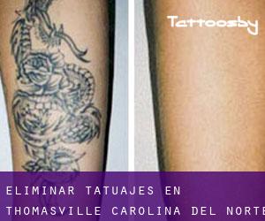 Eliminar tatuajes en Thomasville (Carolina del Norte)