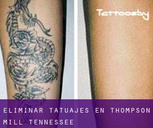 Eliminar tatuajes en Thompson Mill (Tennessee)