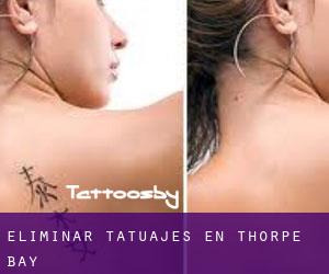 Eliminar tatuajes en Thorpe Bay