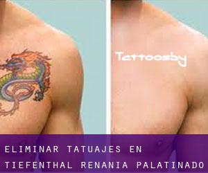 Eliminar tatuajes en Tiefenthal (Renania-Palatinado)