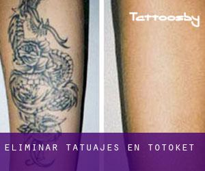 Eliminar tatuajes en Totoket