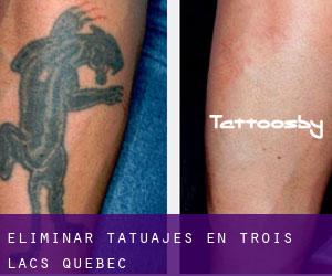 Eliminar tatuajes en Trois-Lacs (Quebec)