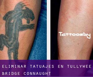 Eliminar tatuajes en Tullywee Bridge (Connaught)