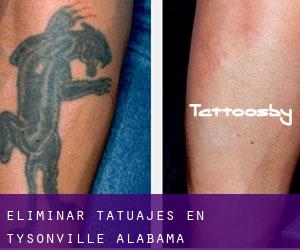 Eliminar tatuajes en Tysonville (Alabama)