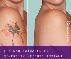 Eliminar tatuajes en University Heights (Indiana)