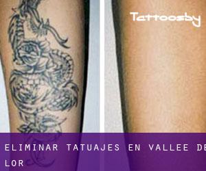 Eliminar tatuajes en Vallée-de-l'Or