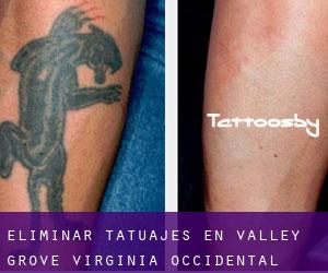 Eliminar tatuajes en Valley Grove (Virginia Occidental)