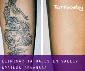 Eliminar tatuajes en Valley Springs (Arkansas)