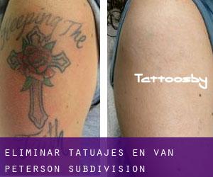 Eliminar tatuajes en Van Peterson Subdivision