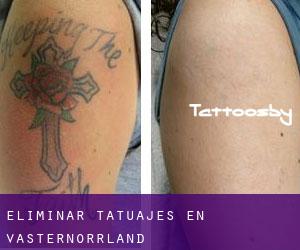 Eliminar tatuajes en Västernorrland