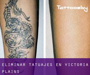 Eliminar tatuajes en Victoria Plains