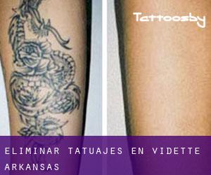 Eliminar tatuajes en Vidette (Arkansas)