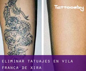Eliminar tatuajes en Vila Franca de Xira