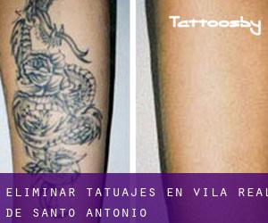 Eliminar tatuajes en Vila Real de Santo António