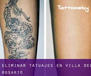 Eliminar tatuajes en Villa del Rosario