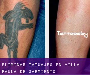 Eliminar tatuajes en Villa Paula de Sarmiento
