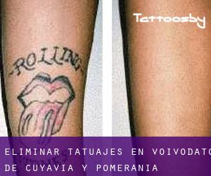 Eliminar tatuajes en Voivodato de Cuyavia y Pomerania