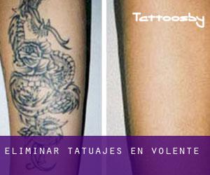 Eliminar tatuajes en Volente